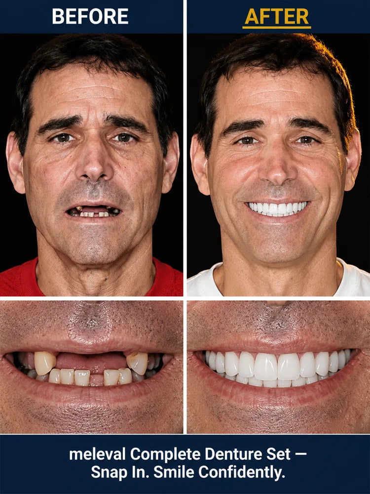 Complete‑Fit Cosmetic Smile Veneer Kit