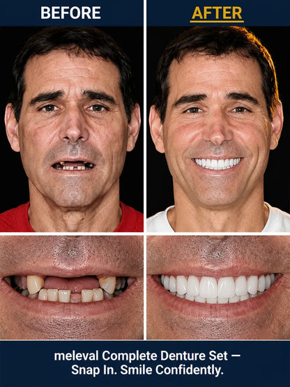 Complete‑Fit Cosmetic Smile Veneer Kit